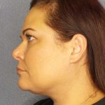 Liposuction of the Neck Before & After Patient #12181
