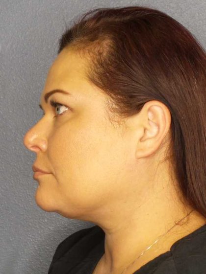 Liposuction of the Neck Before & After Patient #12181