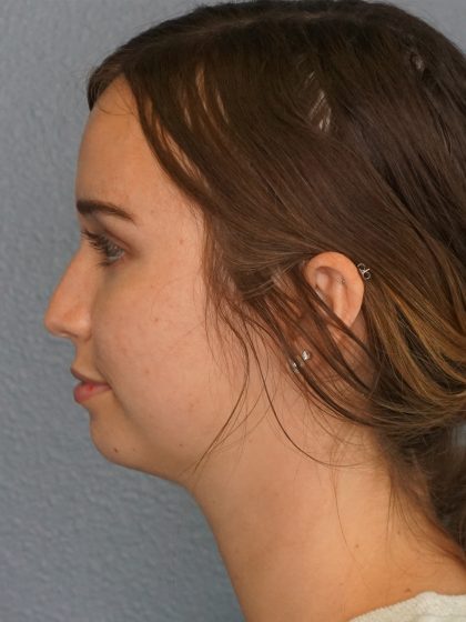Liposuction of the Neck Before & After Patient #12071