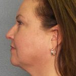 Liposuction of the Neck Before & After Patient #12104
