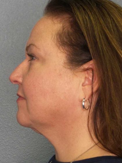 Liposuction of the Neck Before & After Patient #12104