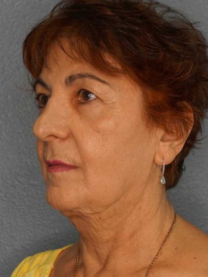 Liposuction of the Neck Before & After Patient #12137