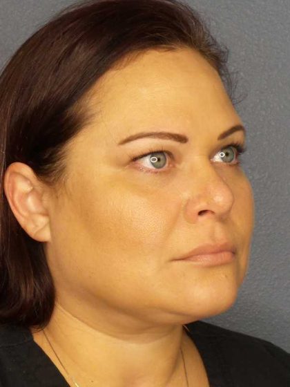 Liposuction of the Neck Before & After Patient #12181