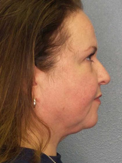 Liposuction of the Neck Before & After Patient #12104