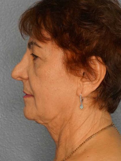 Liposuction of the Neck Before & After Patient #12137