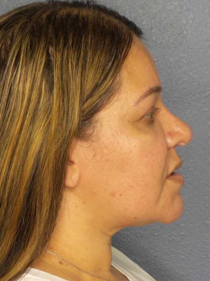 Liposuction of the Neck Before & After Patient #12159