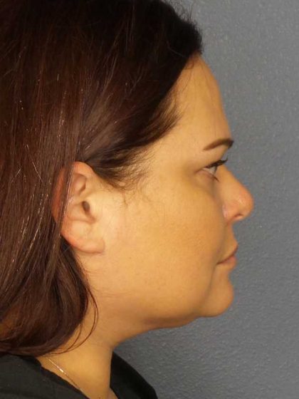 Liposuction of the Neck Before & After Patient #12181