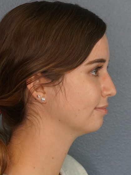 Liposuction of the Neck Before & After Patient #12071