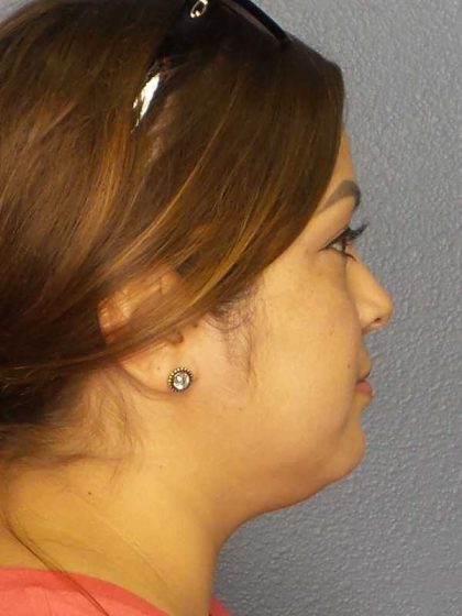 Liposuction of the Neck Before & After Patient #12126