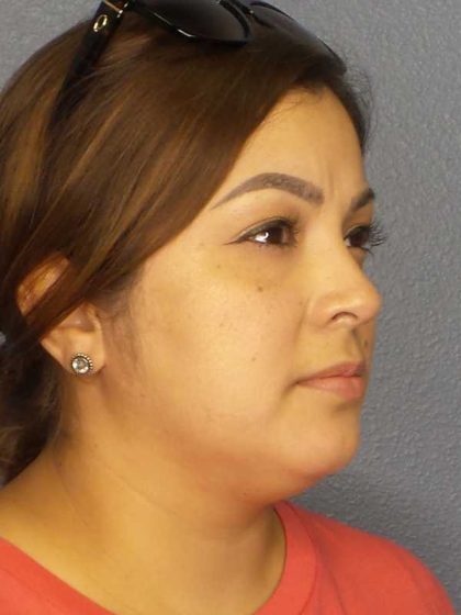 Liposuction of the Neck Before & After Patient #12126