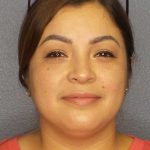 Liposuction of the Neck Before & After Patient #12126