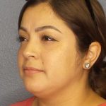 Liposuction of the Neck Before & After Patient #12126