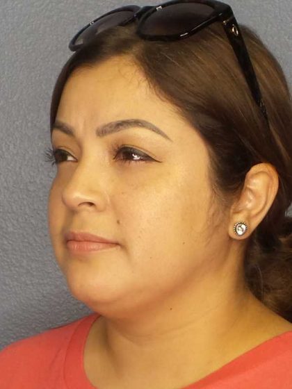 Liposuction of the Neck Before & After Patient #12126