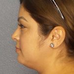Liposuction of the Neck Before & After Patient #12126