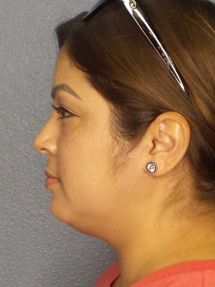 Liposuction of the Neck Before & After Patient #12126