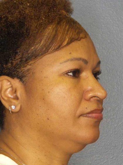 Rhinoplasty Before & After Patient #10805