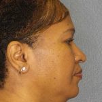 Rhinoplasty Before & After Patient #10805