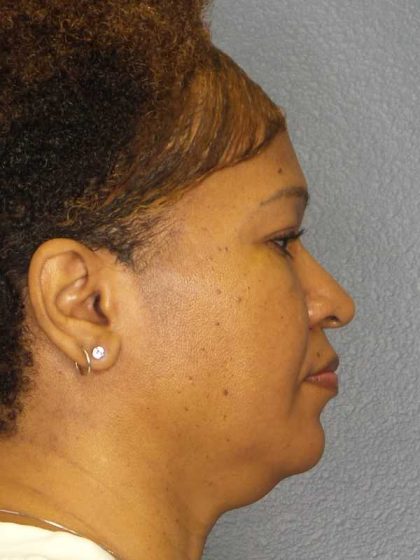 Rhinoplasty Before & After Patient #10805