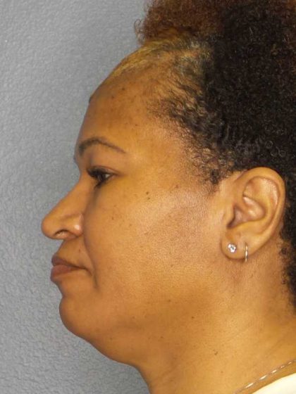 Rhinoplasty Before & After Patient #10805