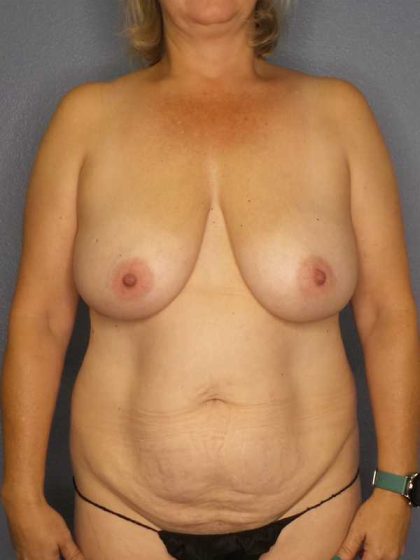 High BMI (Larger Patients) Surgery Before & After Patient #10455