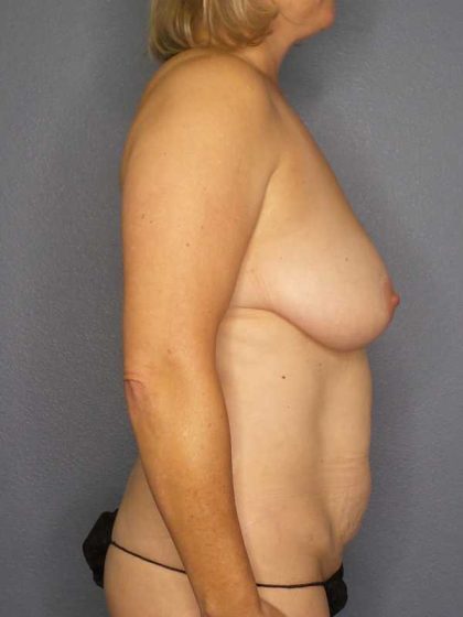 High BMI (Larger Patients) Surgery Before & After Patient #10455