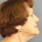 Facelift Before & After Patient #11887