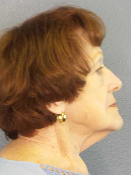 Facelift Before & After Patient #11887