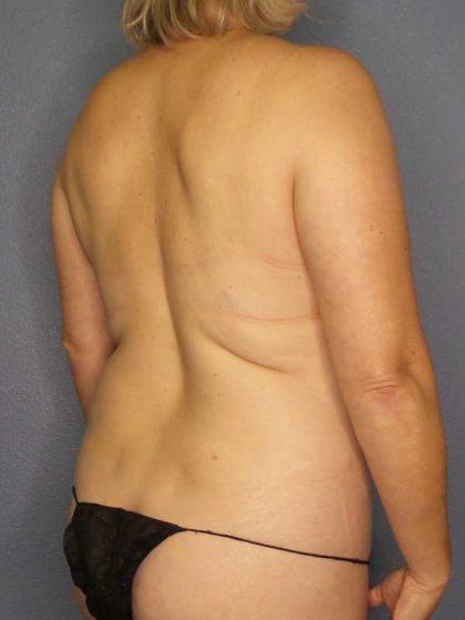 High BMI (Larger Patients) Surgery Before & After Patient #10455