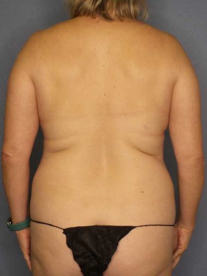 High BMI (Larger Patients) Surgery Before & After Patient #10455