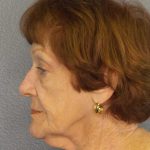 Facelift Before & After Patient #11887