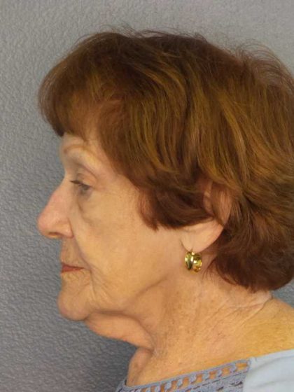 Facelift Before & After Patient #11887