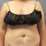 High BMI (Larger Patients) Surgery Before & After Patient #10273