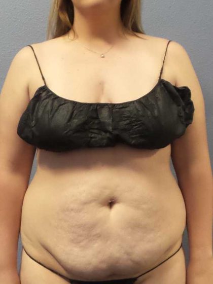 High BMI (Larger Patients) Surgery Before & After Patient #10273