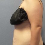 High BMI (Larger Patients) Surgery Before & After Patient #10273
