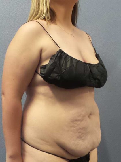 High BMI (Larger Patients) Surgery Before & After Patient #10273