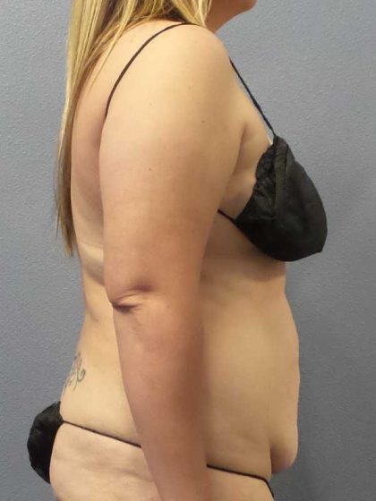 High BMI (Larger Patients) Surgery Before & After Patient #10273