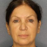 Facelift Before & After Patient #11661