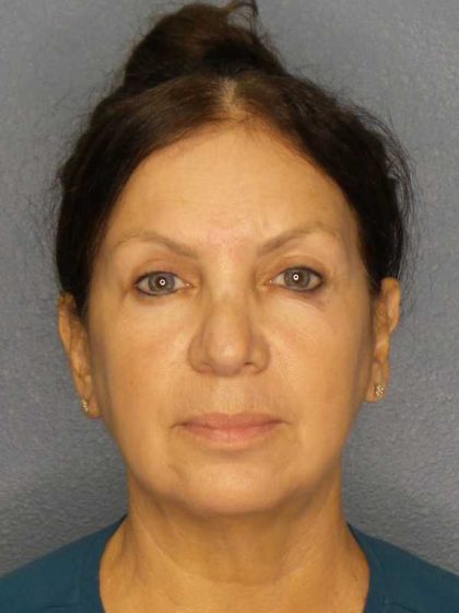 Facelift Before & After Patient #11661