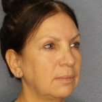 Facelift Before & After Patient #11661