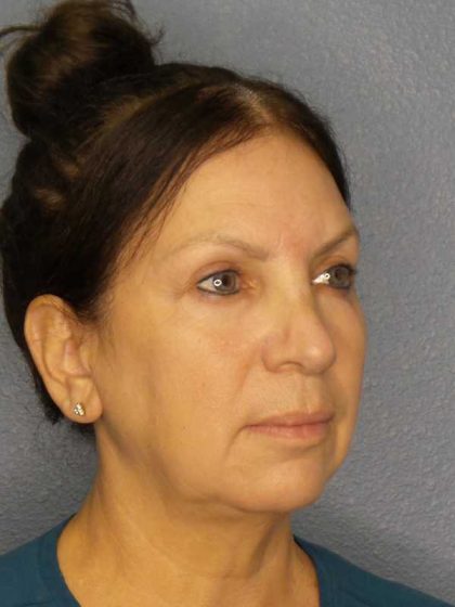 Facelift Before & After Patient #11661
