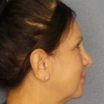 Facelift Before & After Patient #11661