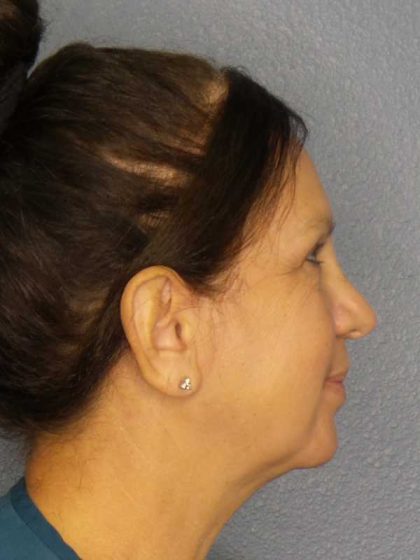 Facelift Before & After Patient #11661
