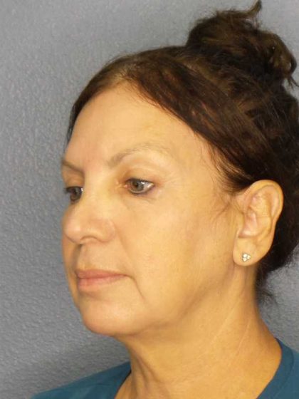 Facelift Before & After Patient #11661