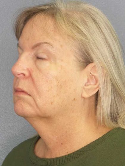 Facelift Before & After Patient #11842