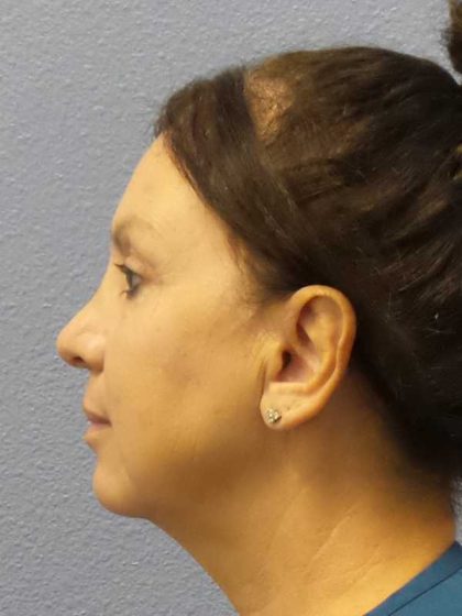 Facelift Before & After Patient #11661