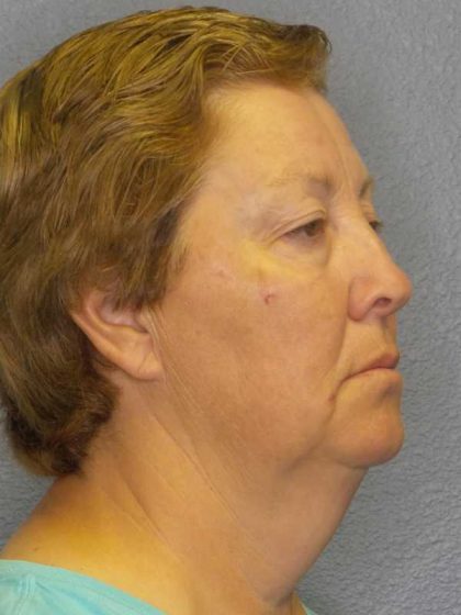 Facelift Before & After Patient #7556