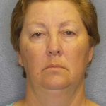 Facelift Before & After Patient #7556