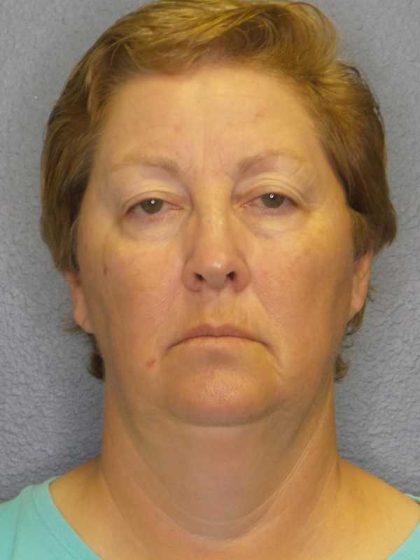 Facelift Before & After Patient #7556