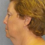 Facelift Before & After Patient #7556