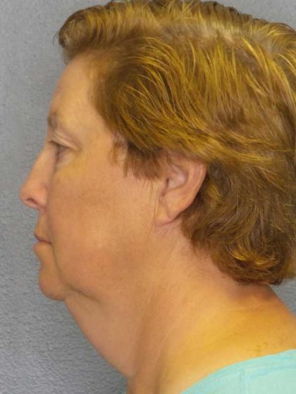 Facelift Before & After Patient #7556